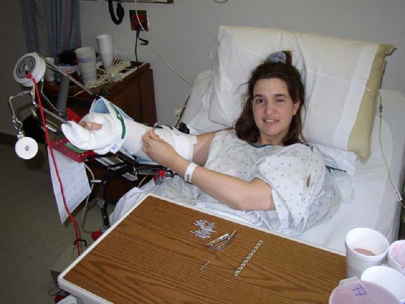 Marla posing with the plates and screws that were removed from her humerus, radius, and ulna in advance during the elbow replacement surgery.