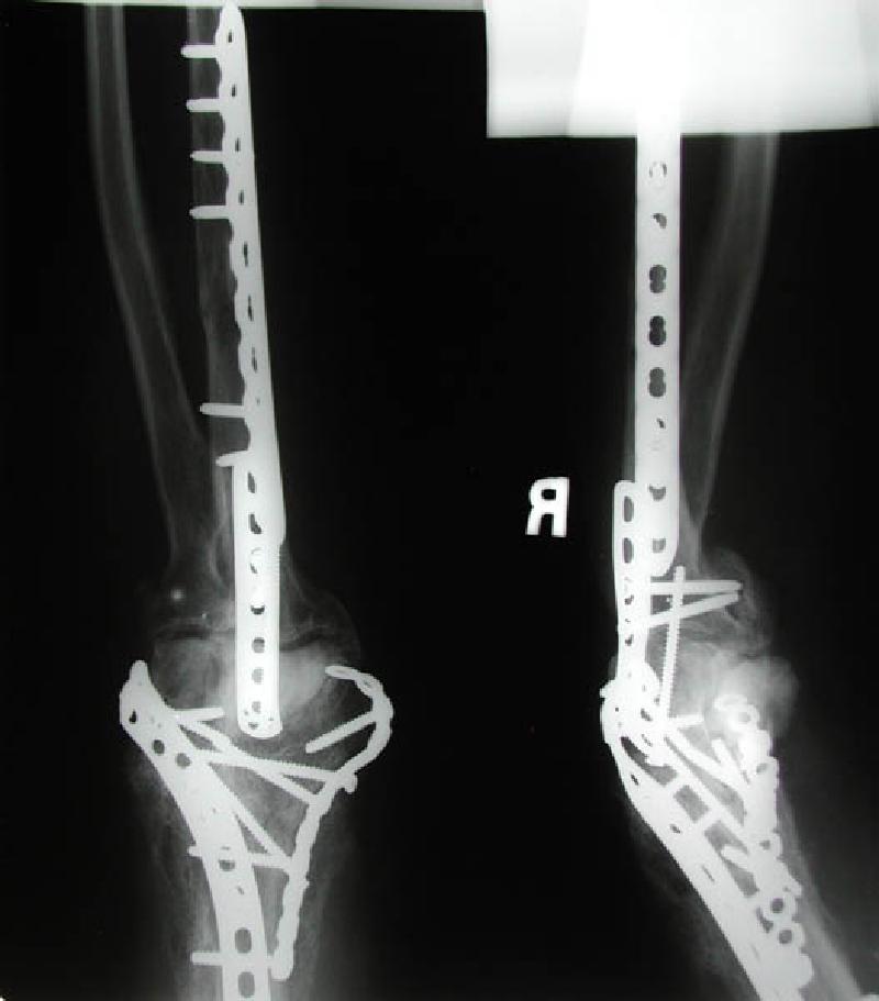 Front and side views of Marla's right elbow before her April 22nd elbow replacement surgery. The screws and plates were emplaced during the first re-construction post-trauma in December 2002. The entire infrastructure was surrounded by and interwoven with excess bone build-up, a common side effect of joint trauma coincident with head trauma. This excess bone had to be removed during her elbow replacement surgery.