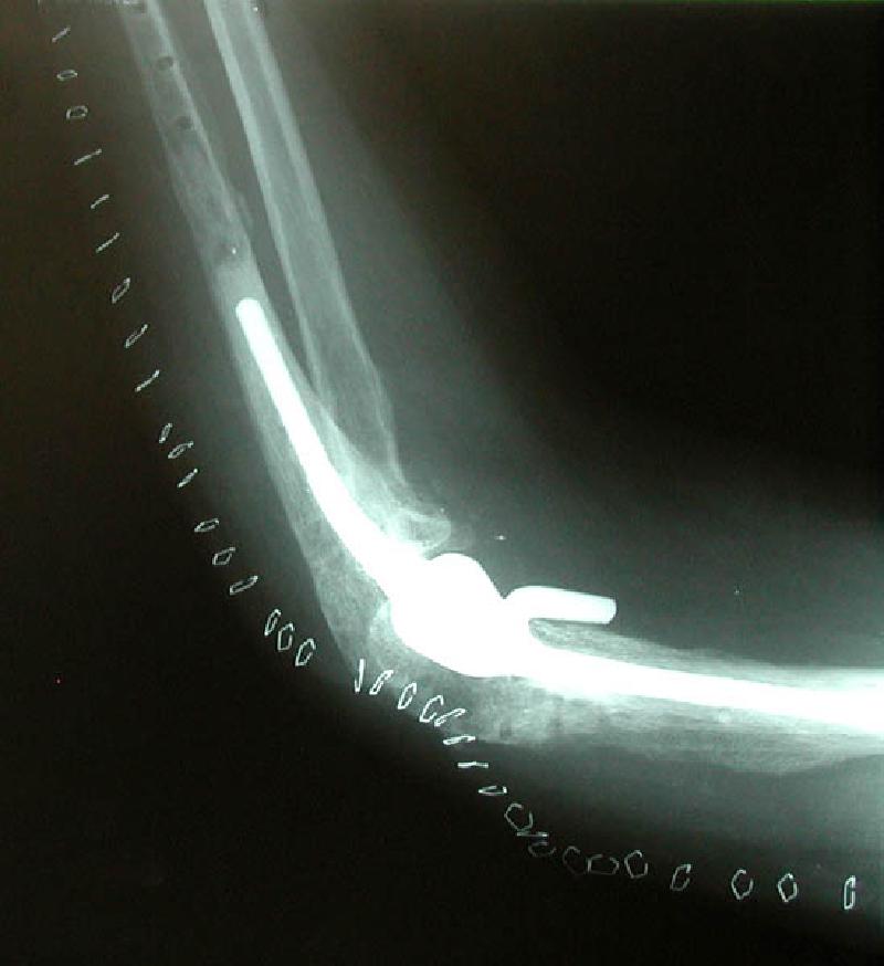 Side and front views of Marla's new artificial elbow joint! You can see the staples that hold the surgical incision closed.