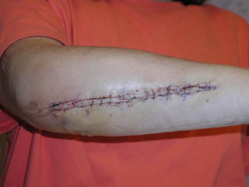 The incision for December's surgery followed the same scar as previous surgeries. Shown are the staples holding the wound closed.