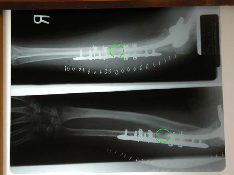 Marla's X-Rays show the repairs that Dr. Sachar performed on Marla's ulnar bone during her surgery on 12/8/2004. The green circles show where her ulna is broken. Dr. Sachar stabilized the bone by embedding a new plate, performing a bone graft in in the break, and utilizing a cadaverous fibula to provide support.